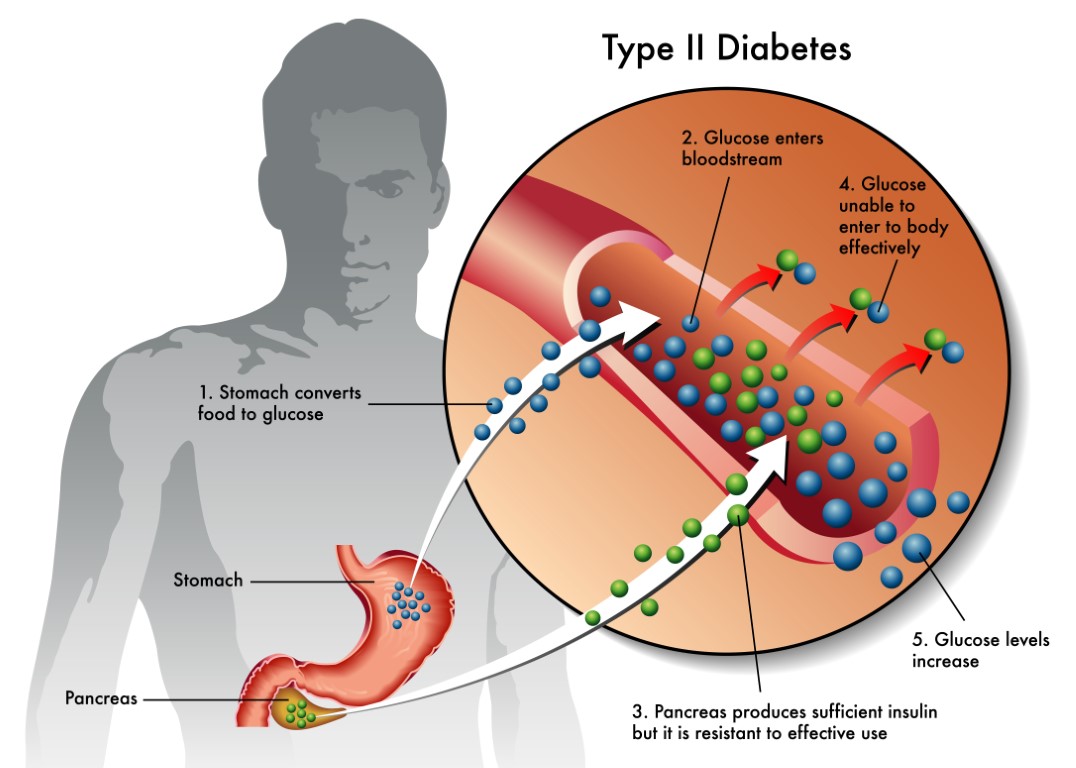 type II diabetes
