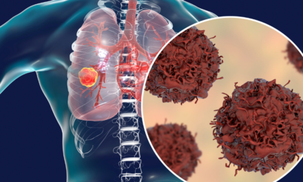 Understanding Lung Disease and Cancer: Types of Carcinoma